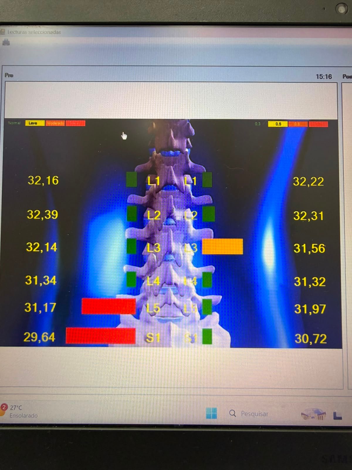 Termografia da Coluna Vertebral - Mapeamento infravermelho de temperatura